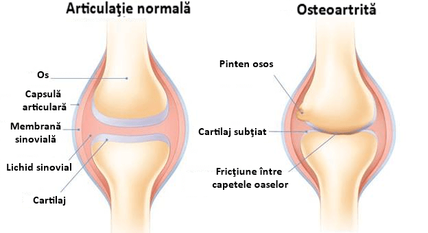 de ce rănesc articulațiile genunchiului când sunt îndoite articulațiile doare simetric