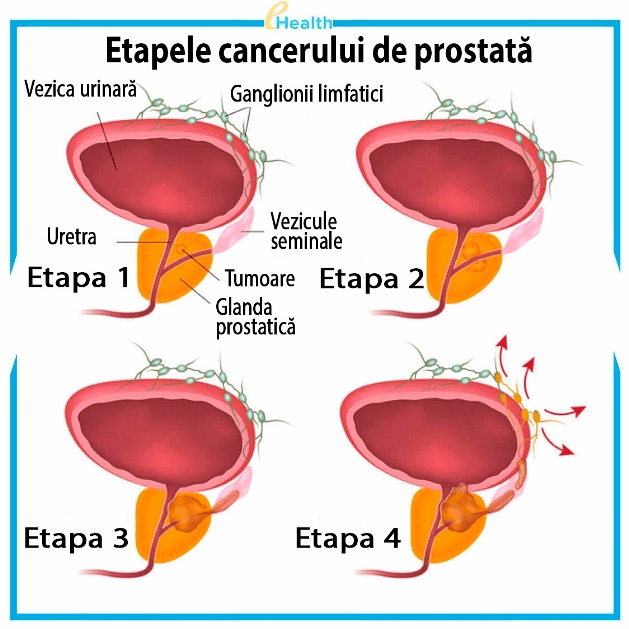 Adenomul de prostata (hipertrofia prostatica benigna)