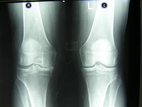 deteriorarea meniscului medial al genunchiului 2 grade artrita juvenila idiopatica