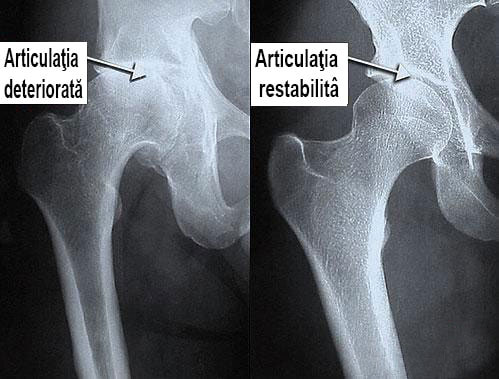 escroci de artropant este posibil să se crească articulațiile cu artrita