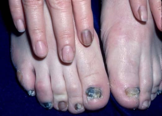 körömgombásodás újbóli fertőzése nail gombák kezelés yuzao