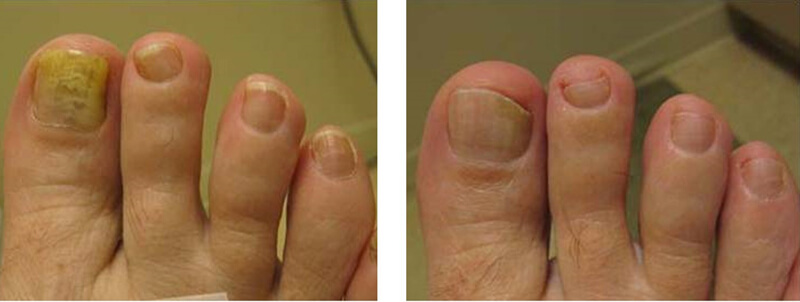 nail fungush lábra gyakorolt ​​hatás a szervezet)
