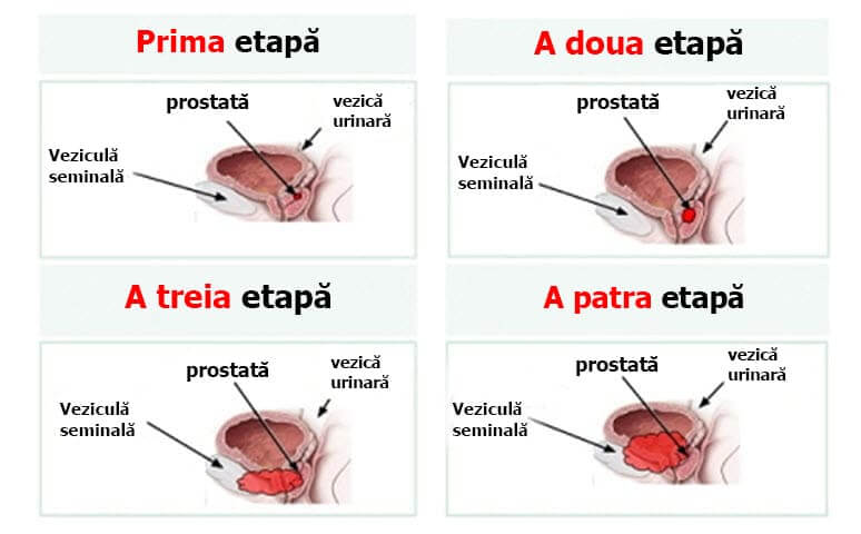 prostate gland removal after effects cancer de prostata operatie cu laser