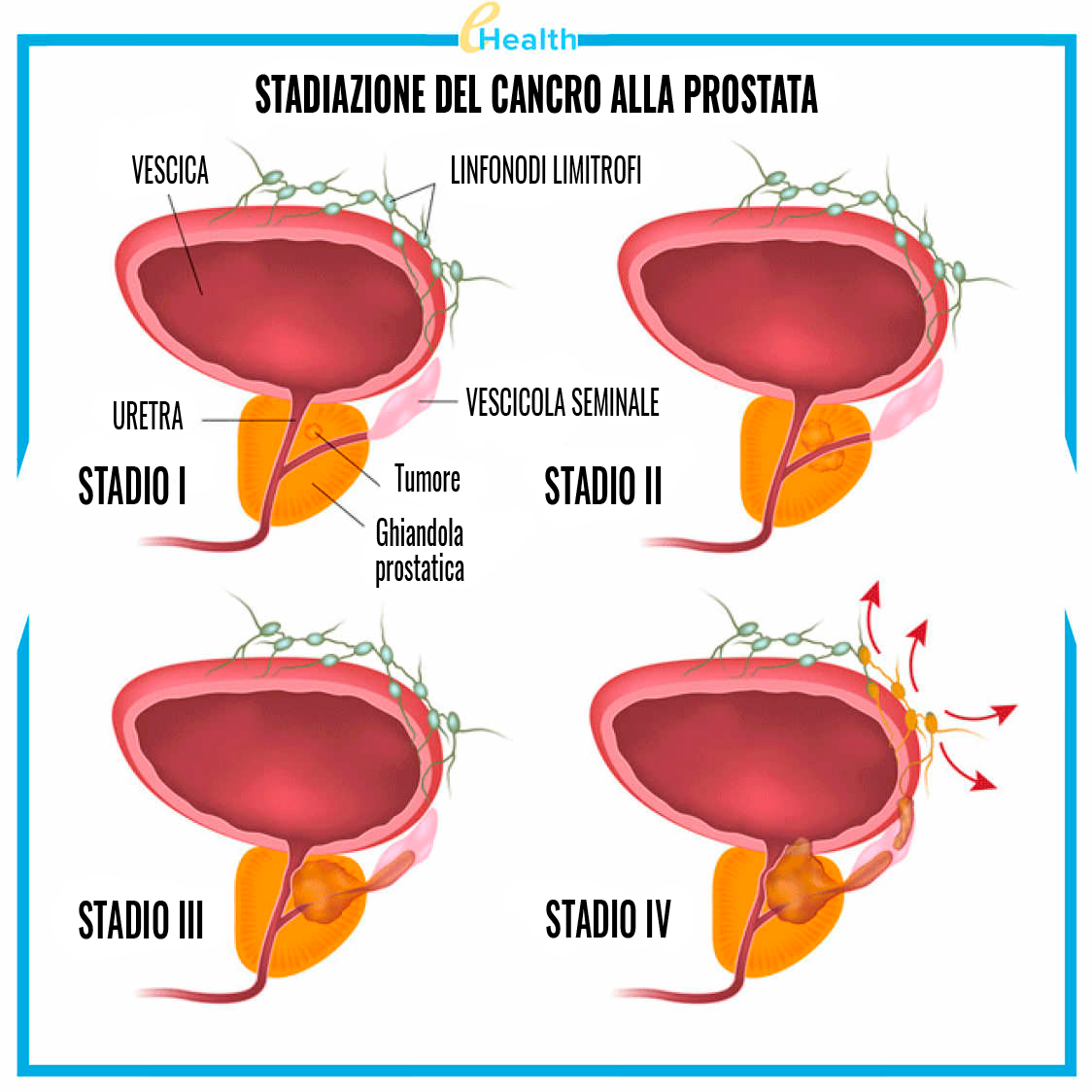 prostata ingrossata tumore histology types of prostate cancer