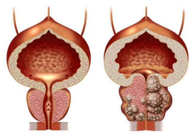 Standard de examinare a adenomului de prostată