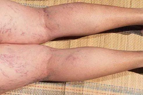 bai de contrast pentru picioare de la varicoza din ce cauza apar varicele pe picioare