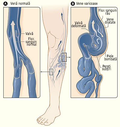 piele subire varicoza sunt genuflexiuni daunatoare pentru varicele piciorului