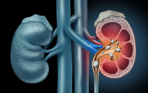consecințe ale prostatitei la rinichi