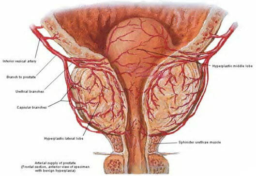 sintomas do cancer de prostata pdf