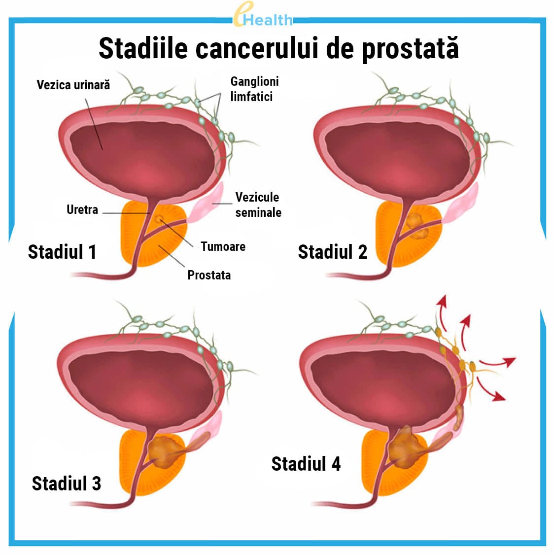 prostatita cronică în stadiul de inflamație latentă