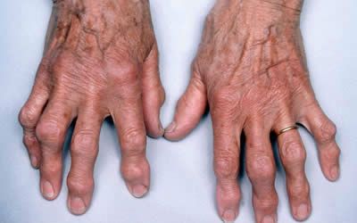 Rheumatoid artritisz is okozhat reggeli ízületi merevséget
