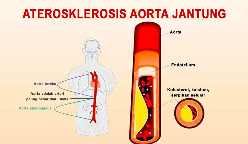 Почему сделать сосуды. Атеросклероз грудного отдела аорты. Клинические проявления атеросклероза аорты. Атеросклероз восходящего отдела аорты. Атеросклеротическое поражение восходящего отдела аорты.